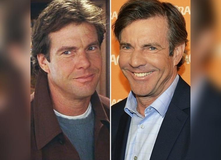 Before and After Plastic Surgery for Dennis Quaid
